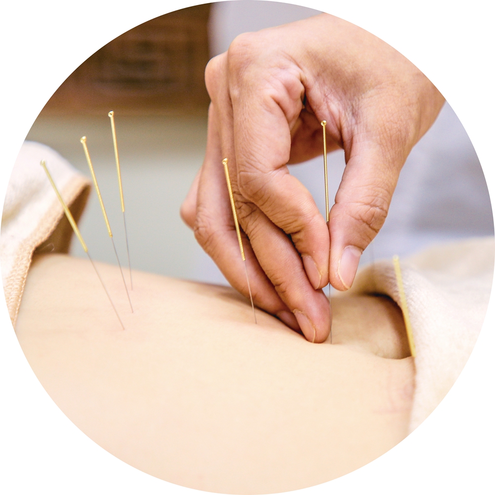 Acupunctuur